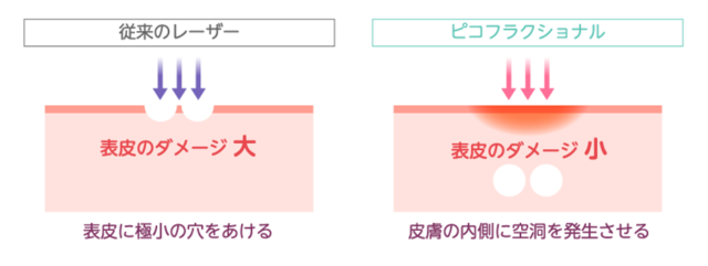従来のフラクショナルレーザーとの違い